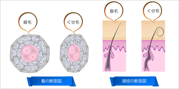 クセ毛の断面図